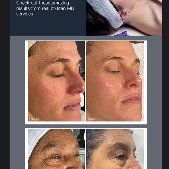 PROFESSIONAL GRADE MICRO-EXFOLIATION PEN MADE BY BIO-THERAPEUTIC - Picture 4 of 13